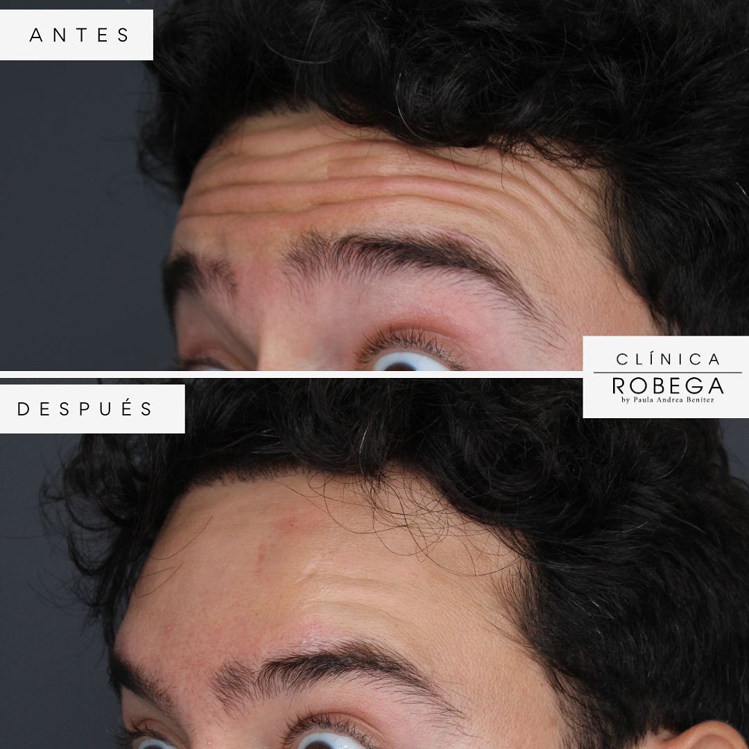 Antes