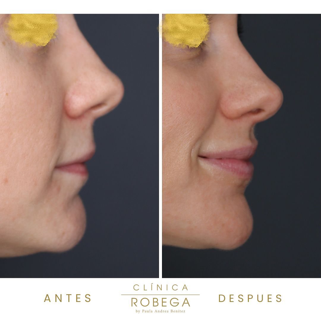 Antes