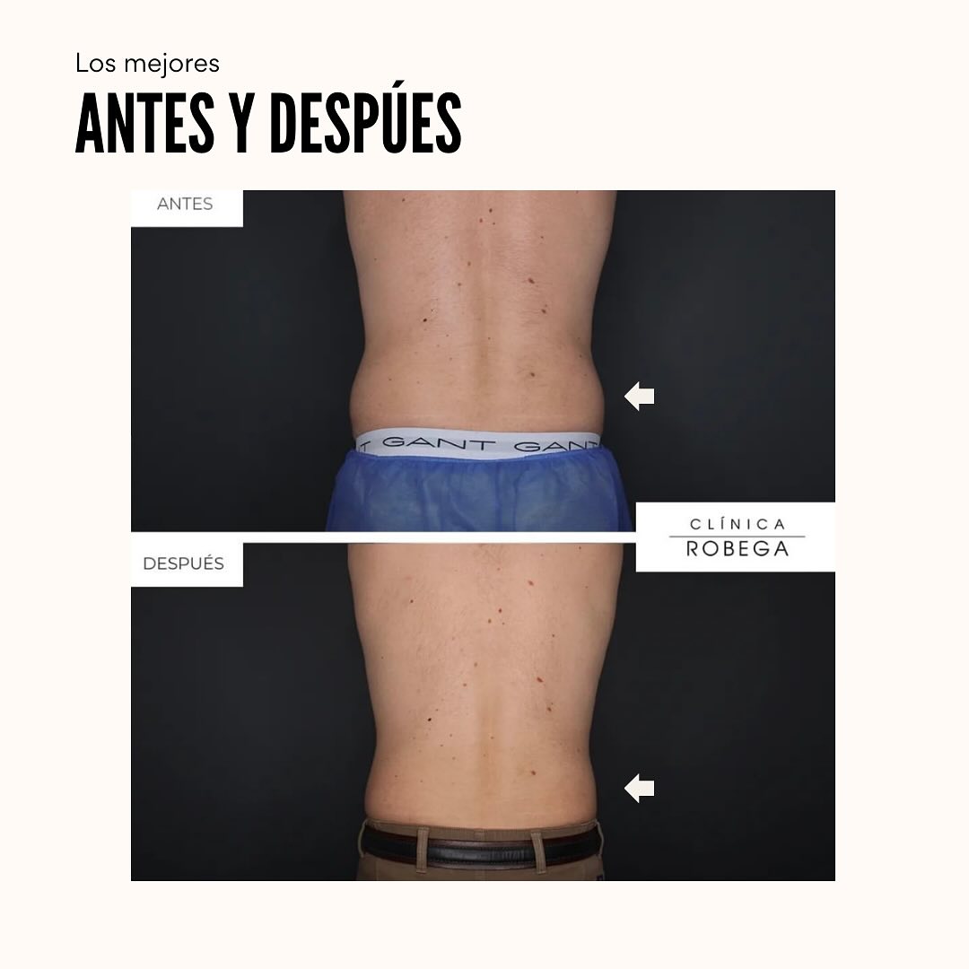 Antes