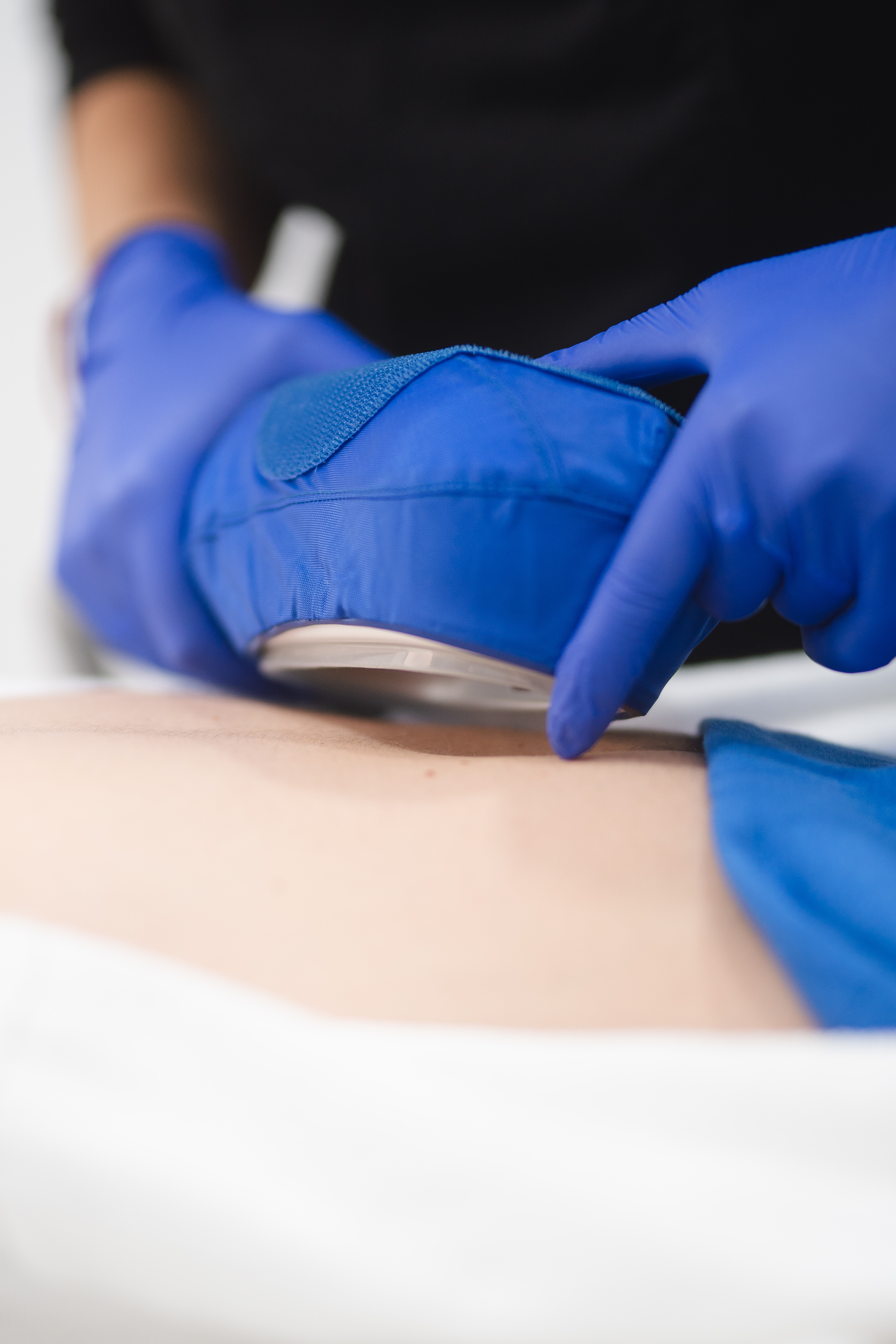 Coolsculpting® - imagen 2