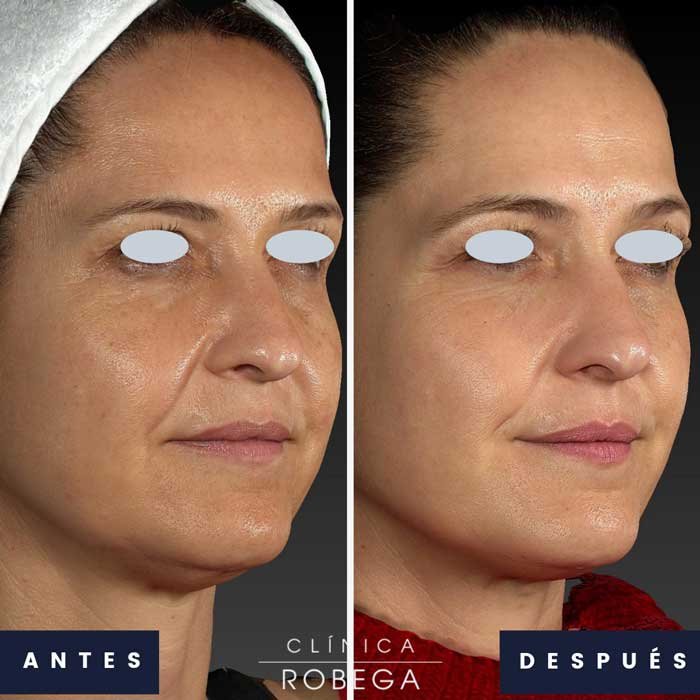 antes y despues tratamiento de manchas en la cara