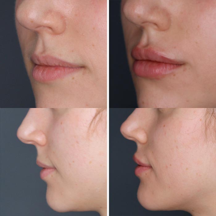 aumento de labios acido hialuronico madrid