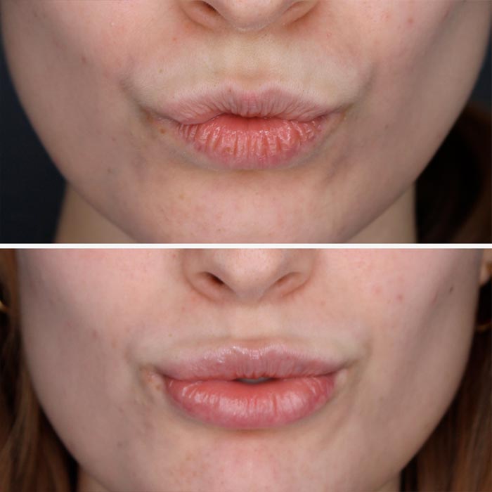 aumento de labios acido hialuronico madrid