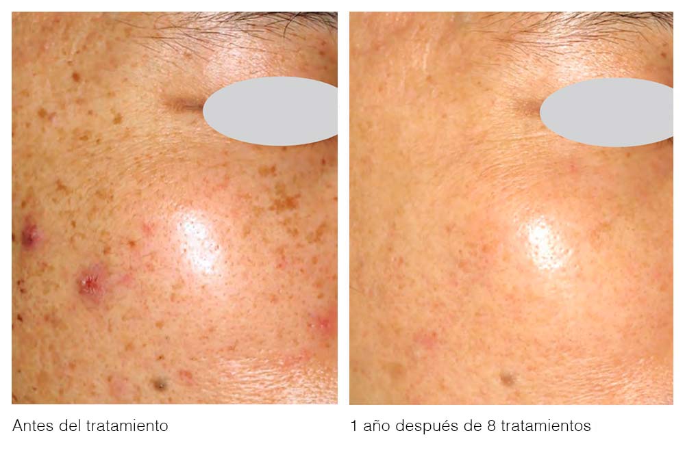 rejuvenecimiento facial con laser antes y despues
