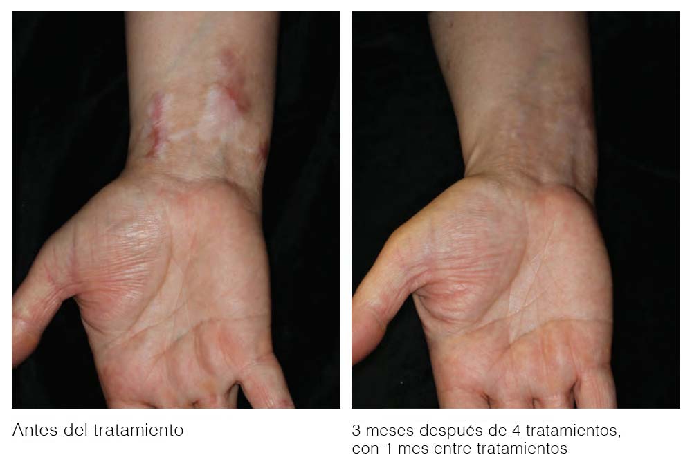 antes y despues clinica tratamiento cicatrices madrid
